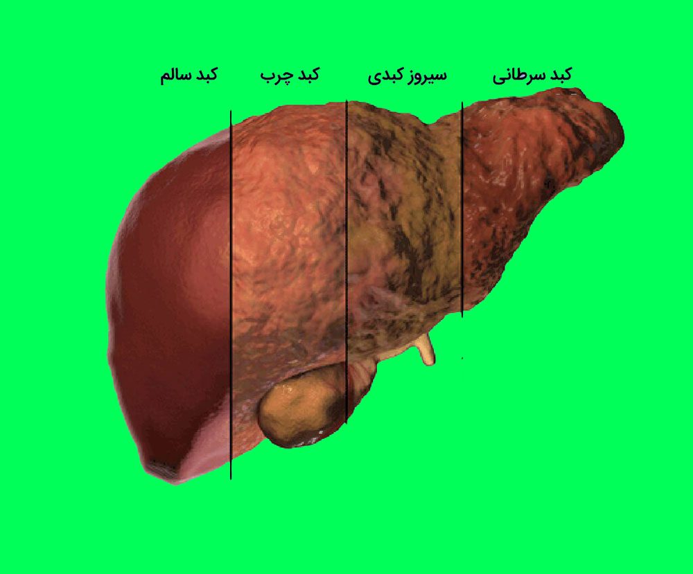 کبد چرب | دکتر حسین ضیائی متخصص گوارش