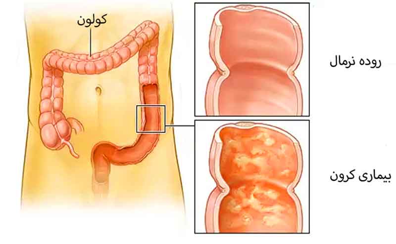 رژیم غذایی بیماری کرون روده