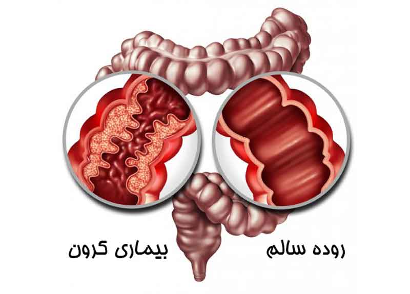 عوارض بیماری کرون روده