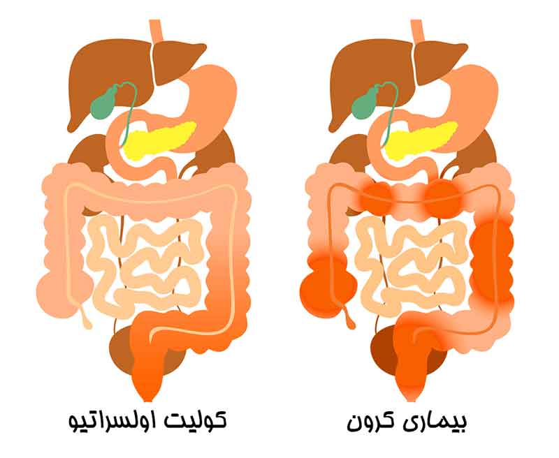 علائم بیماری کرون روده