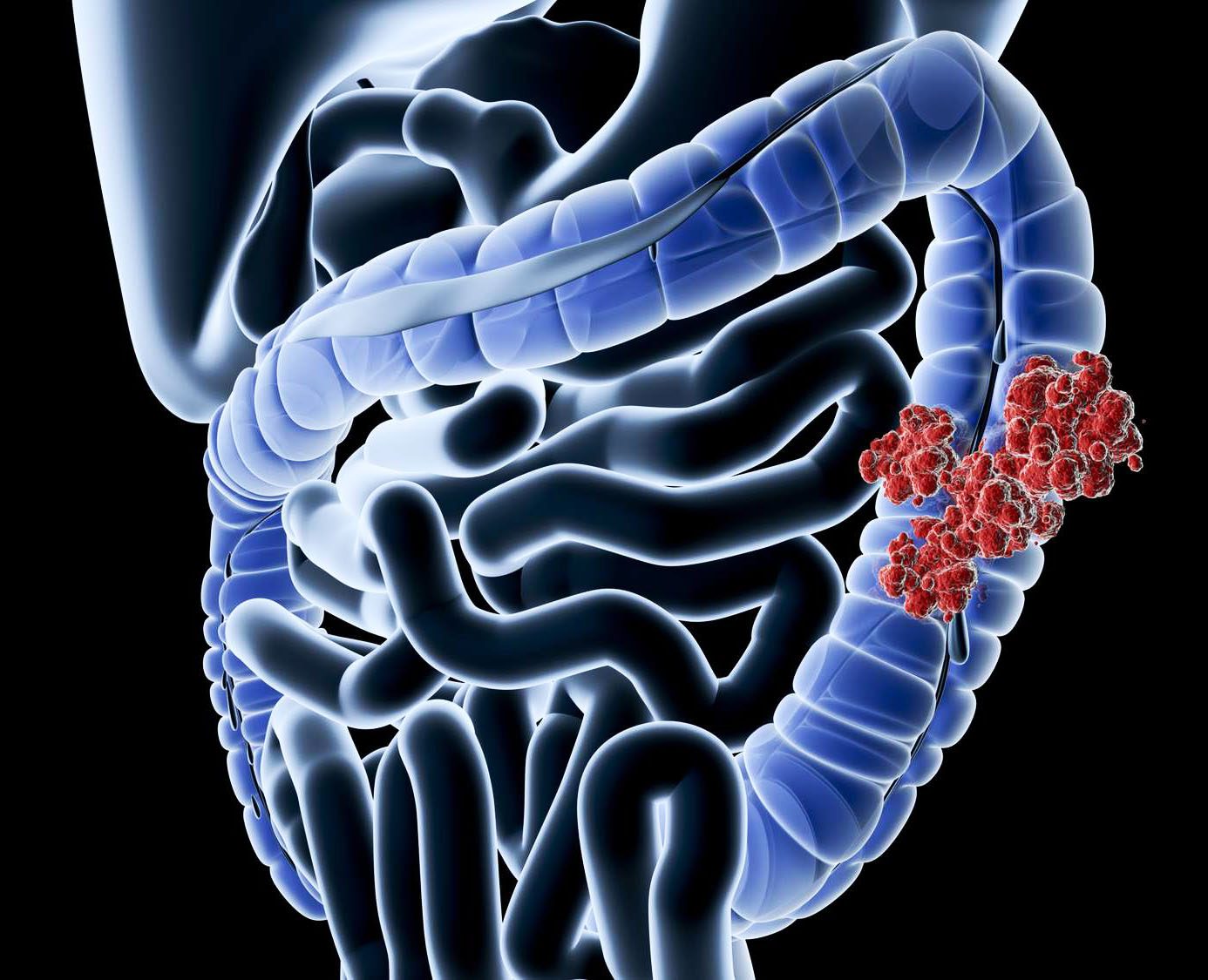 پزشکان چگونه سرطان روده بزرگ را تشخیص می دهند؟
