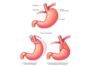 روش های جراحی درمان ریفلاکس معده کدامند؟