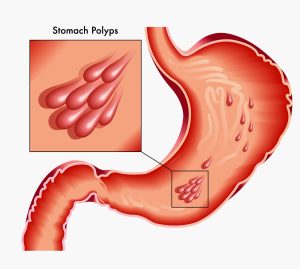 آیا پولیپ معده همان سرطان است