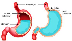 ریفلاکس معده به چه علت صورت می پذیرد؟
