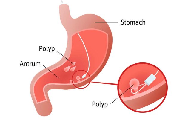 پولیپ معده