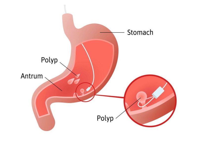 پولیپ معده