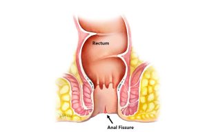 تفاوت شقاق مقعدی و بواسیر چیست؟