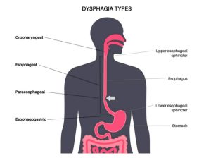 علت دیسفاژی