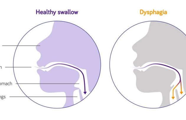 علت مشکل بلع(دیسفاژی) چیست؟و چگونه درمان می شود؟