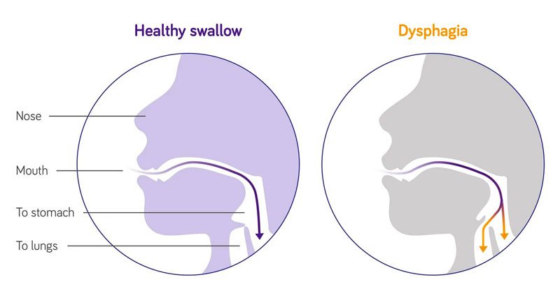 علت مشکل بلع(دیسفاژی) چیست؟و چگونه درمان می شود؟