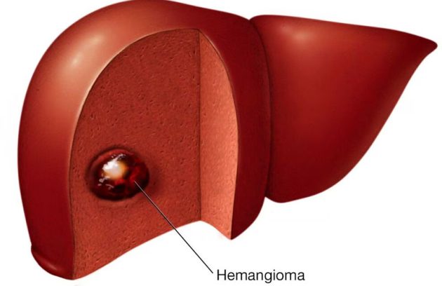 همانژیوم کبدی چیست؟