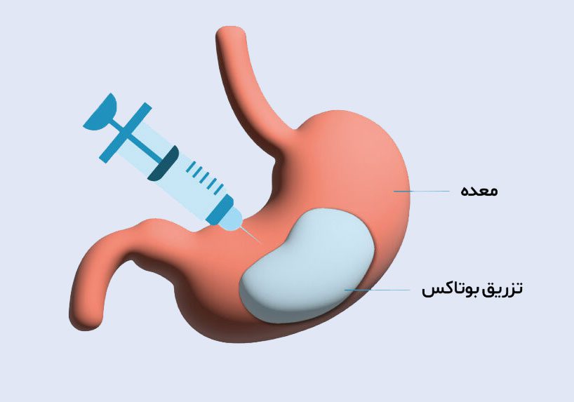 عوارض بوتاکس معده | دکتر حسین ضیائی