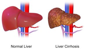 تشخیص سیروز کبدی