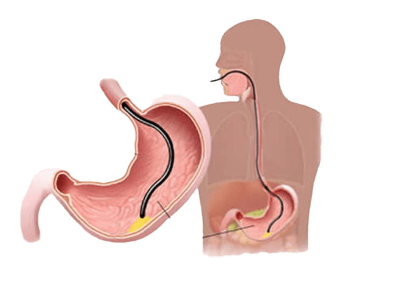 روش انجام بوتاکس معده | دکتر حسین ضیائی