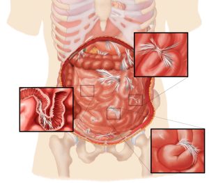 علائم اسنداد روده شامل چه مواردی است؟