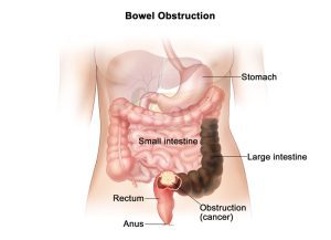 آیا انسداد روده همان سرطان است؟