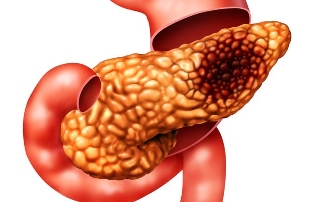 سرطان پانکراس(لوزوالمعده) چیست؟علت، علائم و درمان آن