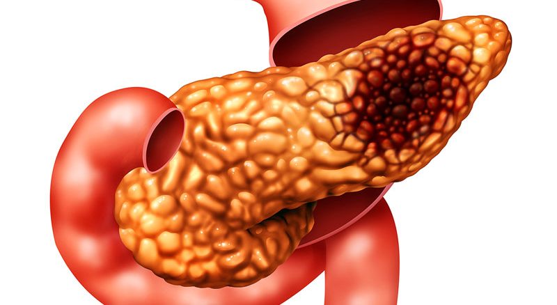سرطان پانکراس(لوزوالمعده) چیست؟علت، علائم و درمان آن