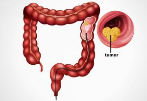 مشکوک بودن به سرطان روده بزرگ