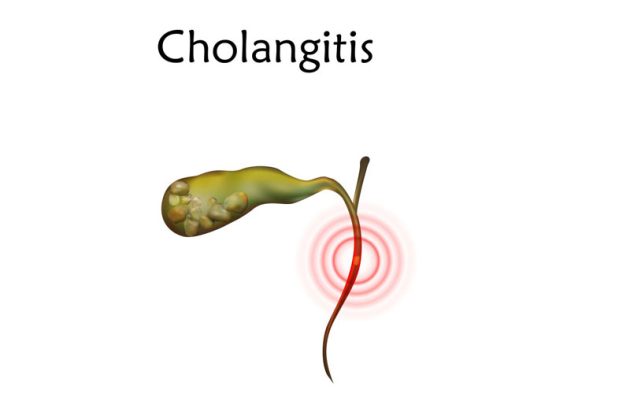عفونت مجاری کیسه صفرا یا کلانژیت چیست؟
