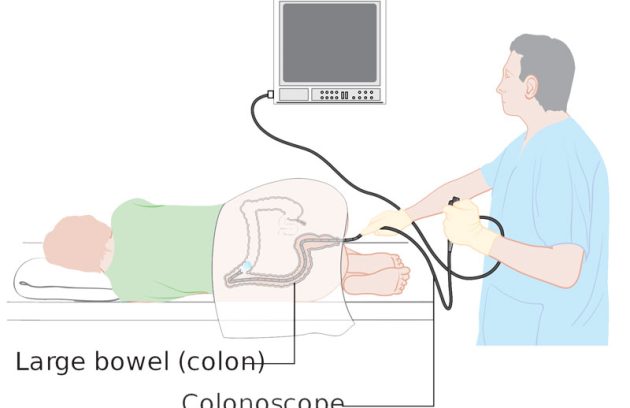 در چه مواردی نیاز به کولونوسکوپی داریم؟
