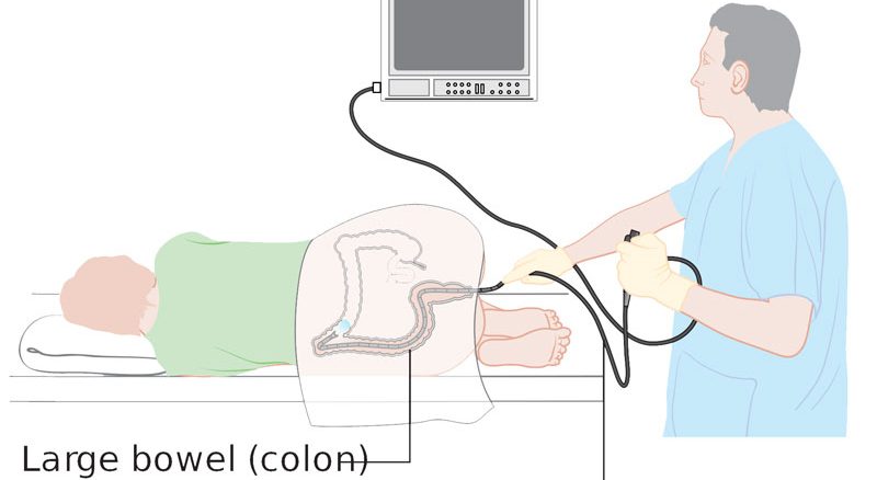 در چه مواردی نیاز به کولونوسکوپی داریم؟