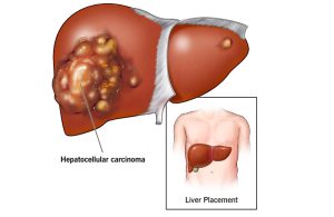 برا پیشگیری از توده بدخیم کبدی چه باید کرد؟