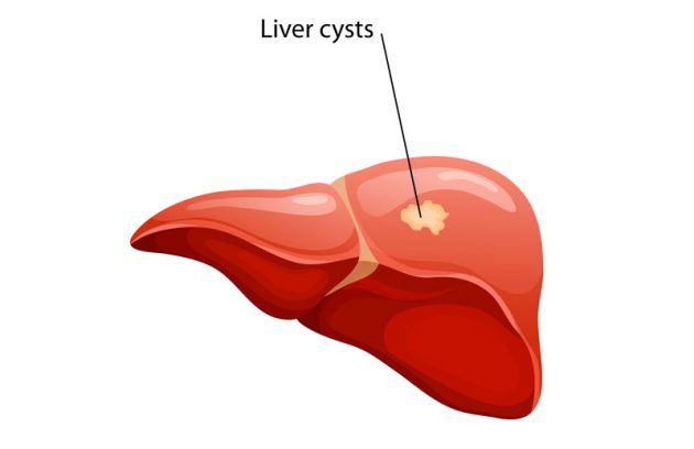 کیست های کبدی چیست؟علت، علائم و درمان