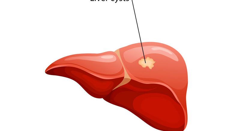 کیست های کبدی چیست؟علت، علائم و درمان