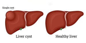 علائم پاره شدن کیست کبد چیست؟