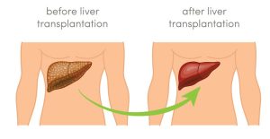 پیوند کبد در چه مواردی انجام می شود؟