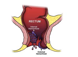 درمان خونریزی مقعدی به چه شکل است؟