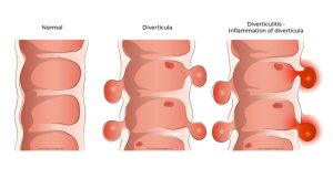 علل دیورتیکول