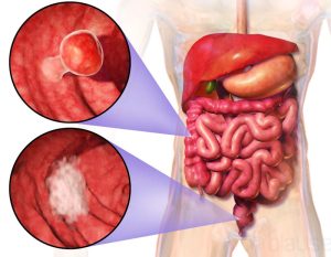 پولیپ روده بزرگ و سرطان روده بزرگ