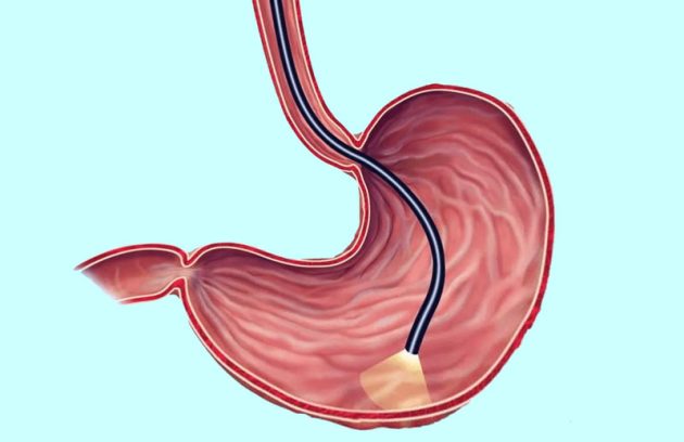 درآندوسکوپی چه چیزی مشخص می شود؟