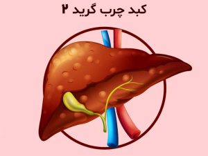 درمان کبد چرب گرید 2