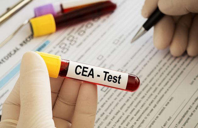 علل افزایش CEA