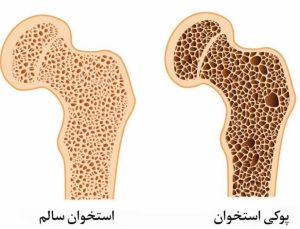 پوکی استخوان چیست؟